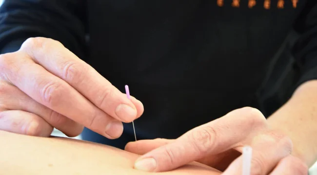 Dry Needling